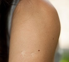 keratosis-pilaris