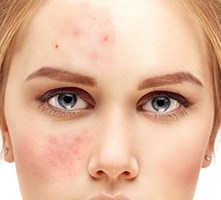 rosacea